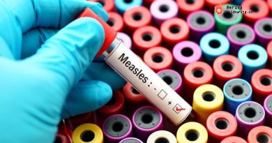 Viral Ruce Nuenda Berkeliaran saat Sakit Campak, Ini Gejala, Risikonya, dan Reaksinya